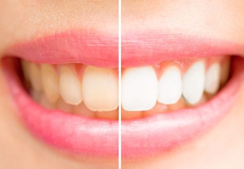 Top Food Choices To Keep Your Teeth White And  Brighten Your Smile
